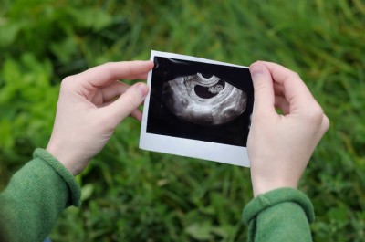 Ultrasound photographs of pregnancy