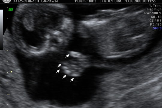 Primeira ultrassonografia. “Dormi Mãe”.