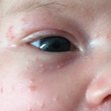 Como tratar e prevenir as brotoejas em bebês