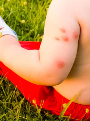 Como proteger seu bebê de picadas de mosquitos?