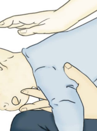 Série Criança Segura: O que fazer para desengasgar uma criança?